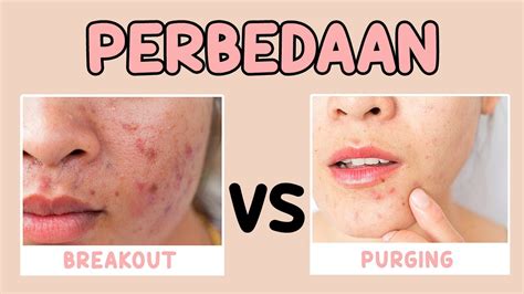 Perbedaan Purging dan Breakout Setelah Penggunaan Skincare