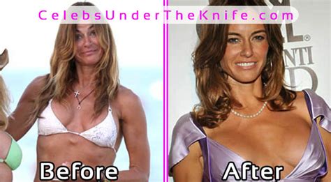 breast augmentation fail