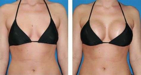 breast augmentation oklahoma