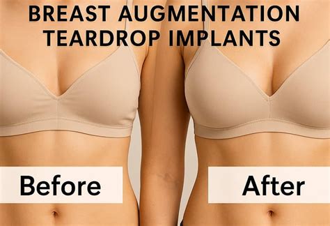breast augmentation teardrop implants