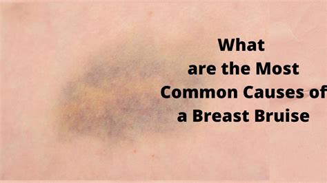Understanding and Healing a Bruised Breast Bone Effectively