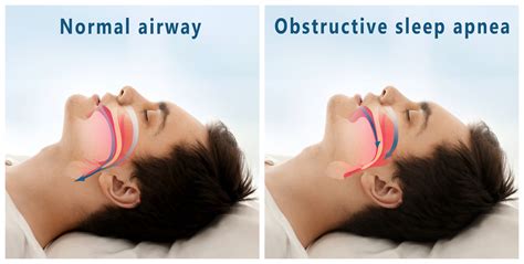 breathing exercises for central sleep apnea