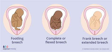 Breech 30 Weeks Should Worried