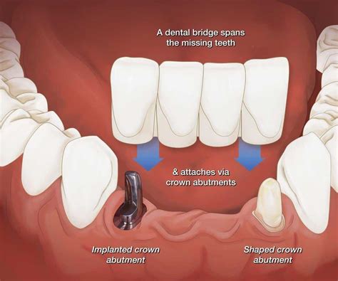 Bridge Abutment Crown Code