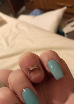 Dealing With A Broken Nail Underneath Acrylic: Tips And Solutions