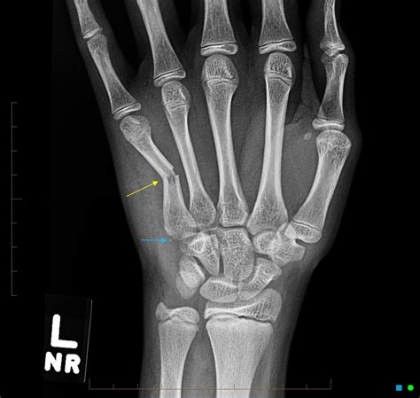 Understanding and Managing a Broken 5th Metacarpal Bone: Causes, Symptoms, and Treatment Options