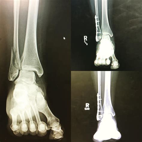 broken ankle x-ray