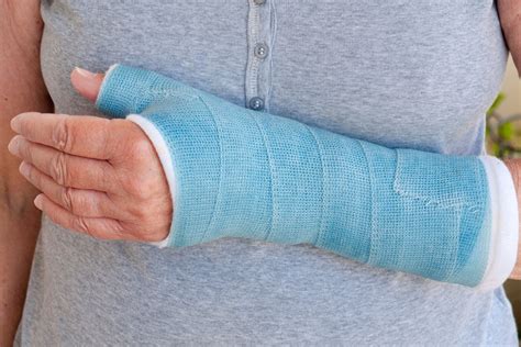 broken arm cast