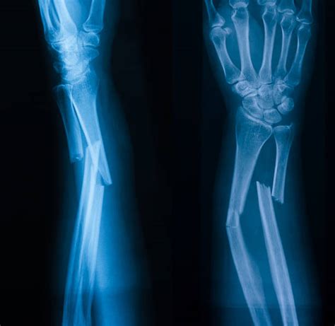 broken arm x-ray