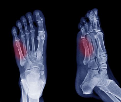 broken bones in foot near toes