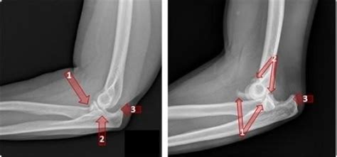 Broken Elbow Vs Bruised