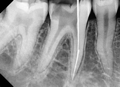 Broken File Left In Root Canal