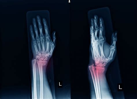 Understanding and Managing a Broken Fractured Wrist: Symptoms, Treatment, and Recovery