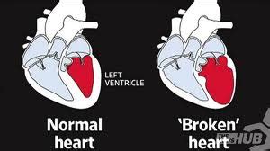 broken heart medical condition