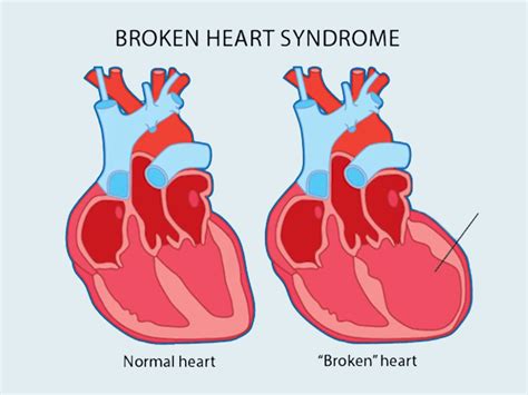 broken heart syndrome heart