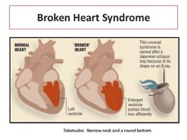 broken heart syndrome real name