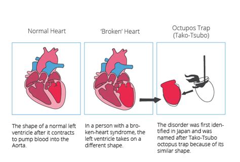 broken heart syndrome wiki