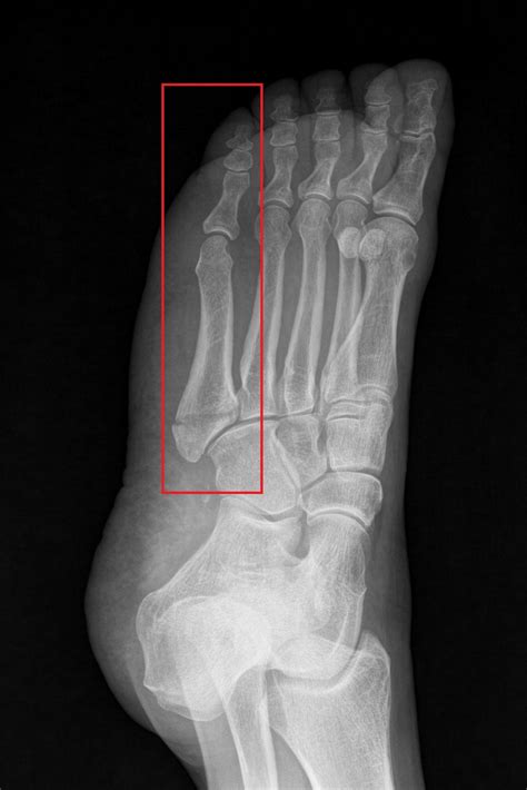 Healing a Broken Metatarsal 5: Recovery Tips and Treatment Options