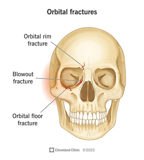 Understanding and Treating a Broken Orbital Bone Effectively