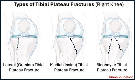 Understanding and Managing a Broken Tibial Plateau: Causes, Symptoms, and Treatment Options