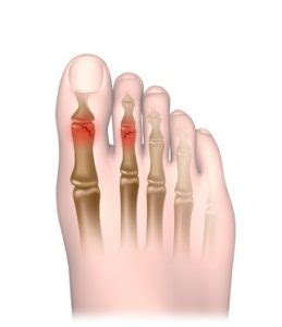 Broken Toe Healing: Speed Up Your Recovery Process Today