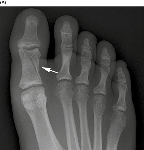 broken toe pain after 2 weeks