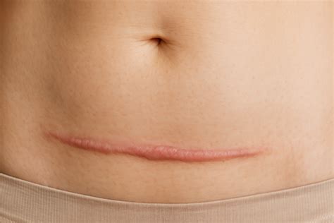 Brown C Section Scar