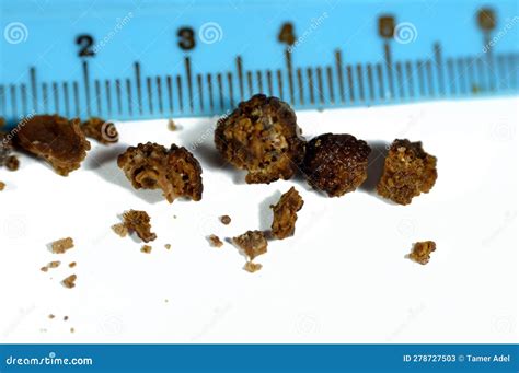 Brown Kidney Stone