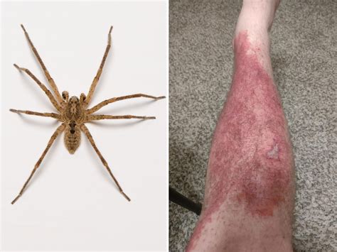 Warning Signs: How to Identify and Treat Brown Recluse Spider Bites Effectively
