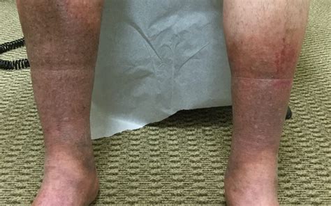 brown spots on lower legs pictures