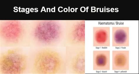 bruise color correction