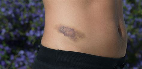 bruise hip