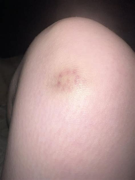 Bruise With Dot In Middle