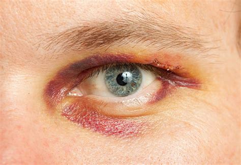 bruised eye conspiracy