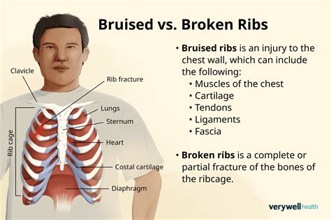 Can You Have a Bruised Rib with No Mark on the Skin? Understanding the Hidden Dangers