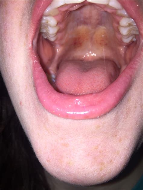 bruised throat from head