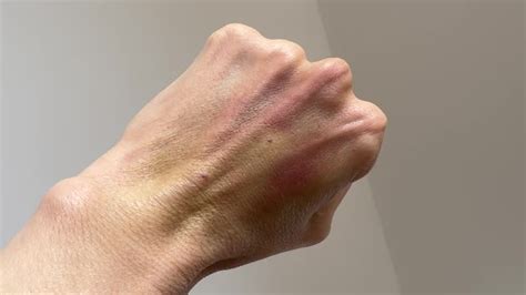 bruises hands