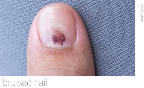Bruises on Finger Nails: Causes, Symptoms, and Effective Treatments