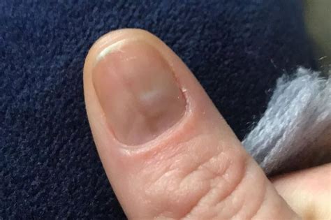 What Causes Bruises Under the Fingernail and How to Treat Them Effectively