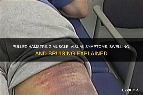 bruising from a pulled hamstring