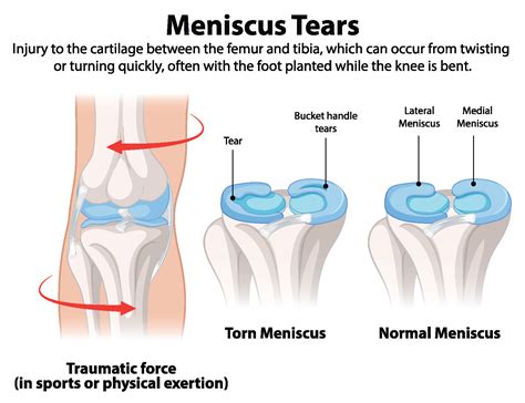 bruising from torn meniscus