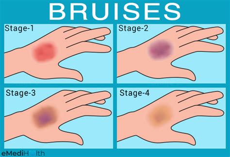 bruising of tissue is referred to as a