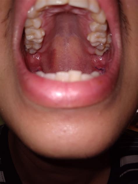 bruising soft palate