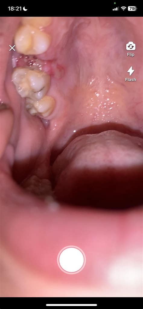 Bubbles In Tooth Socket
