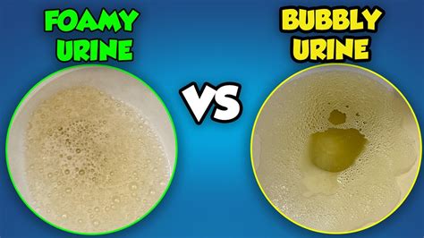 Bubbles In Urine Boy