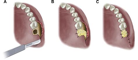 buccal fat pad flap shifting by itself