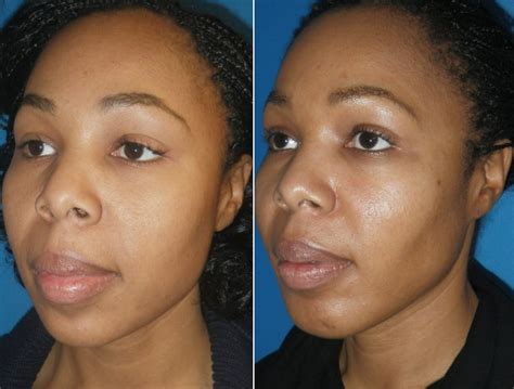 buccal fat pad reduction