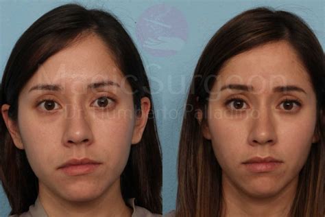 buccal fat removal 10 years later