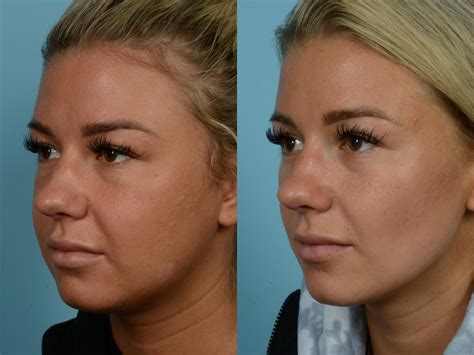 buccal fat removal and face lift