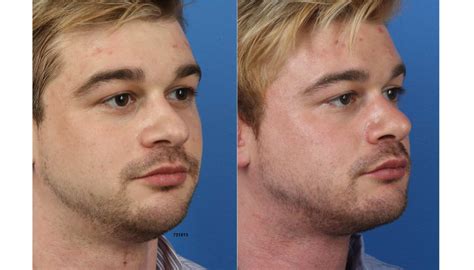 buccal fat removal before after male